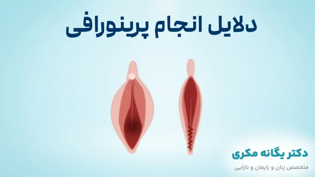 دلایل انجام پرینورافی
